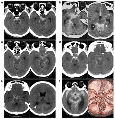 Current status of perimesencephalic non-aneurysmal subarachnoid hemorrhage